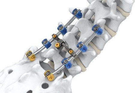 Is Spine Surgery Safe? Recovery Stages and Post-Op Care