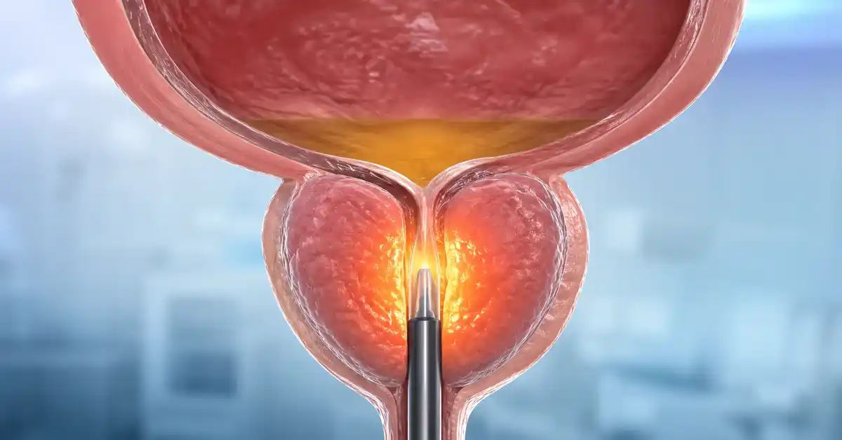 Thermal Therapy for Enlarged Prostate
