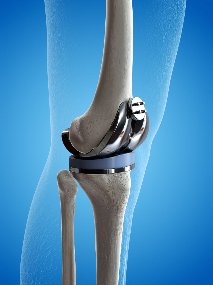 Top Knee Replacement Technologies Available in Turkey