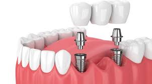 Dental implant 