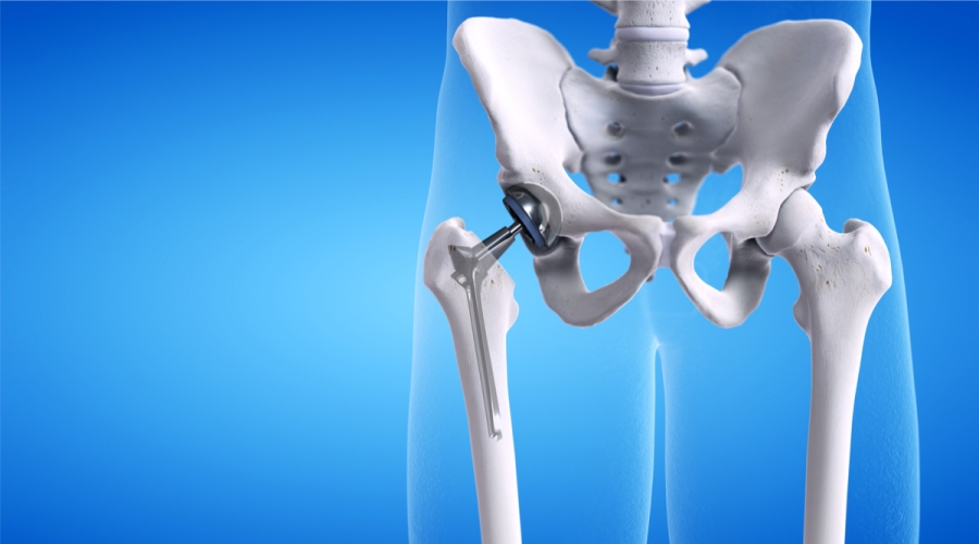 When Do You Need Hip Replacement Surgery? Essential Guidelines