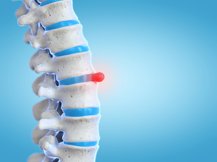 Chronic Disc Herniation: When Is Surgical Intervention Needed?