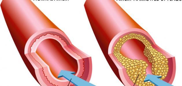 Symptoms of Coronary Artery Blockage and Treatment Options