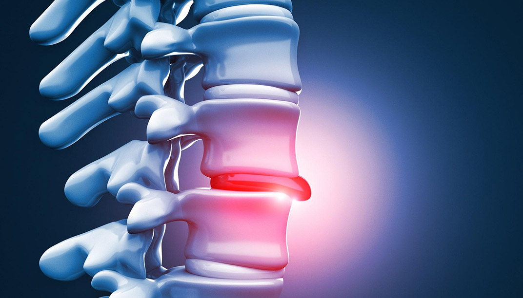 Herniated Disc Surgery: When Is It Necessary? Full Recovery Guide