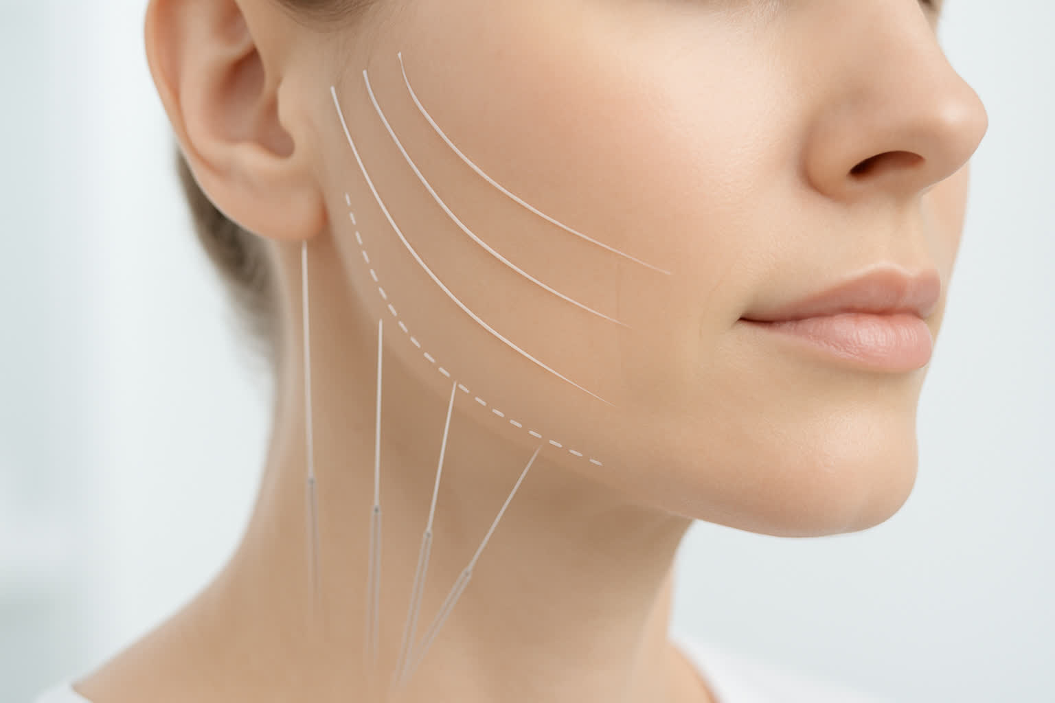Thread Face Lift: Non-Surgical Technique with Quick Results