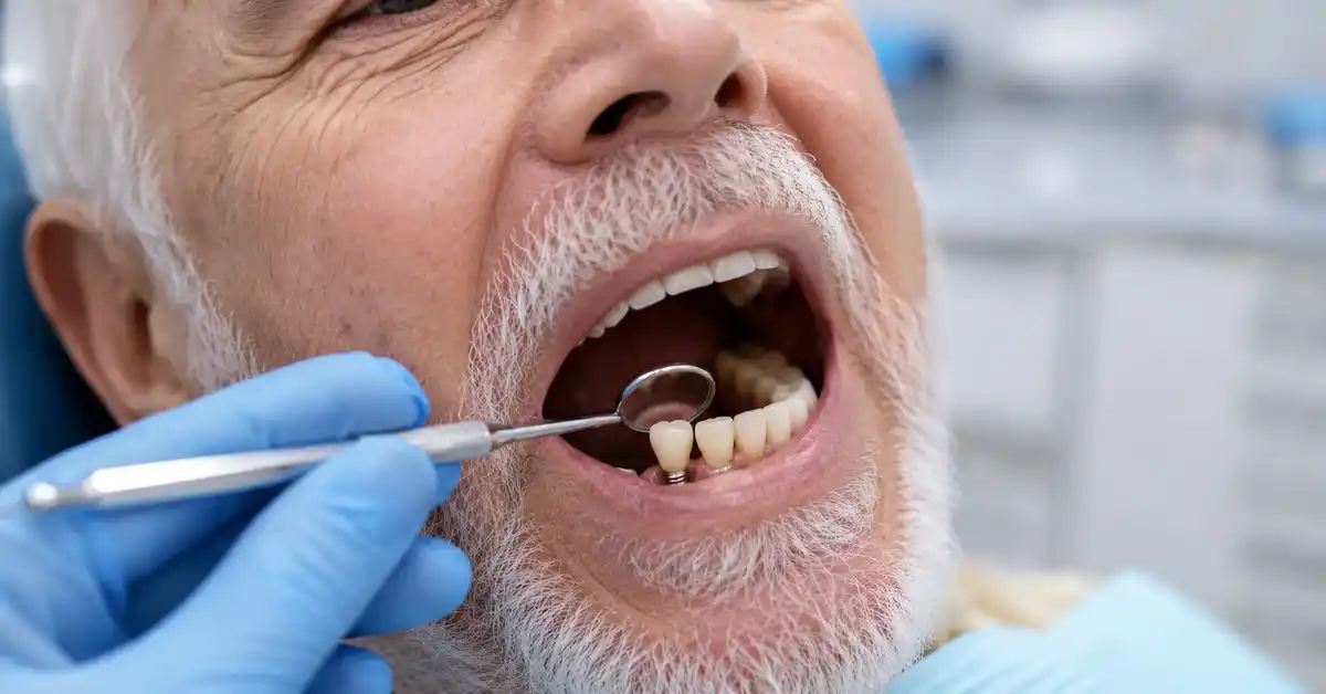 Dental Implants for Seniors: What to Expect