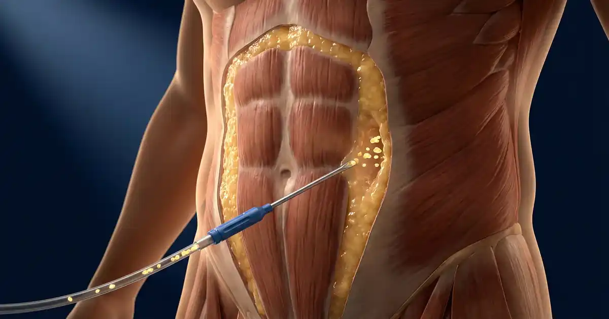 Liposuction for Men Over 40: Safe Tips and Techniques