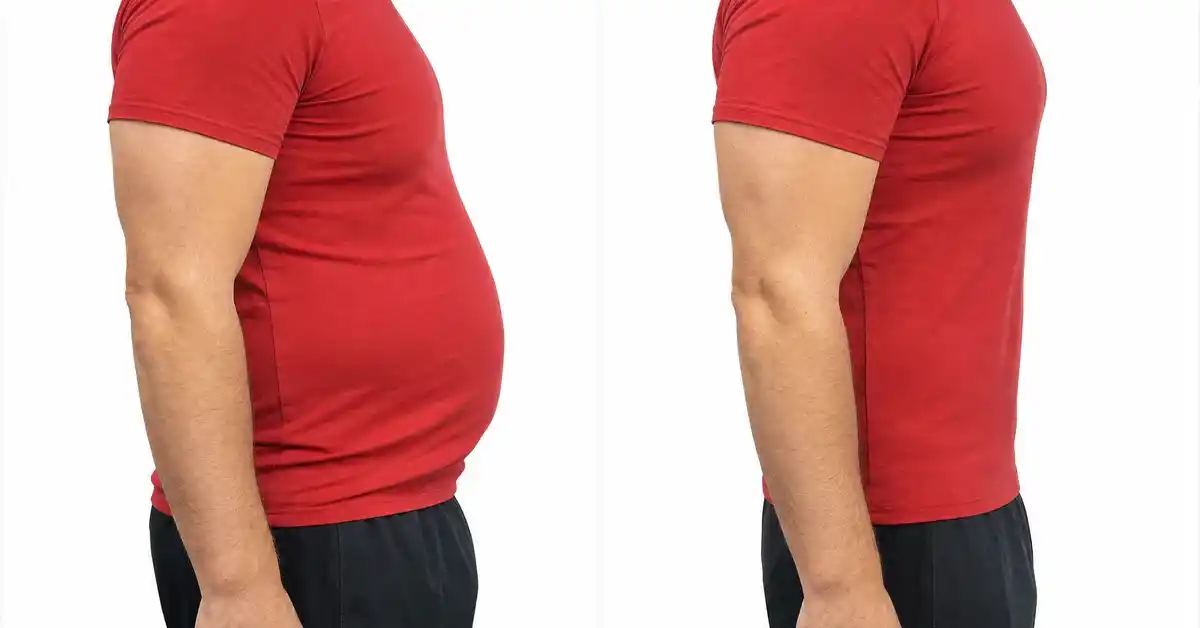 Male Liposuction: Benefits and Latest Fat Removal Techniques