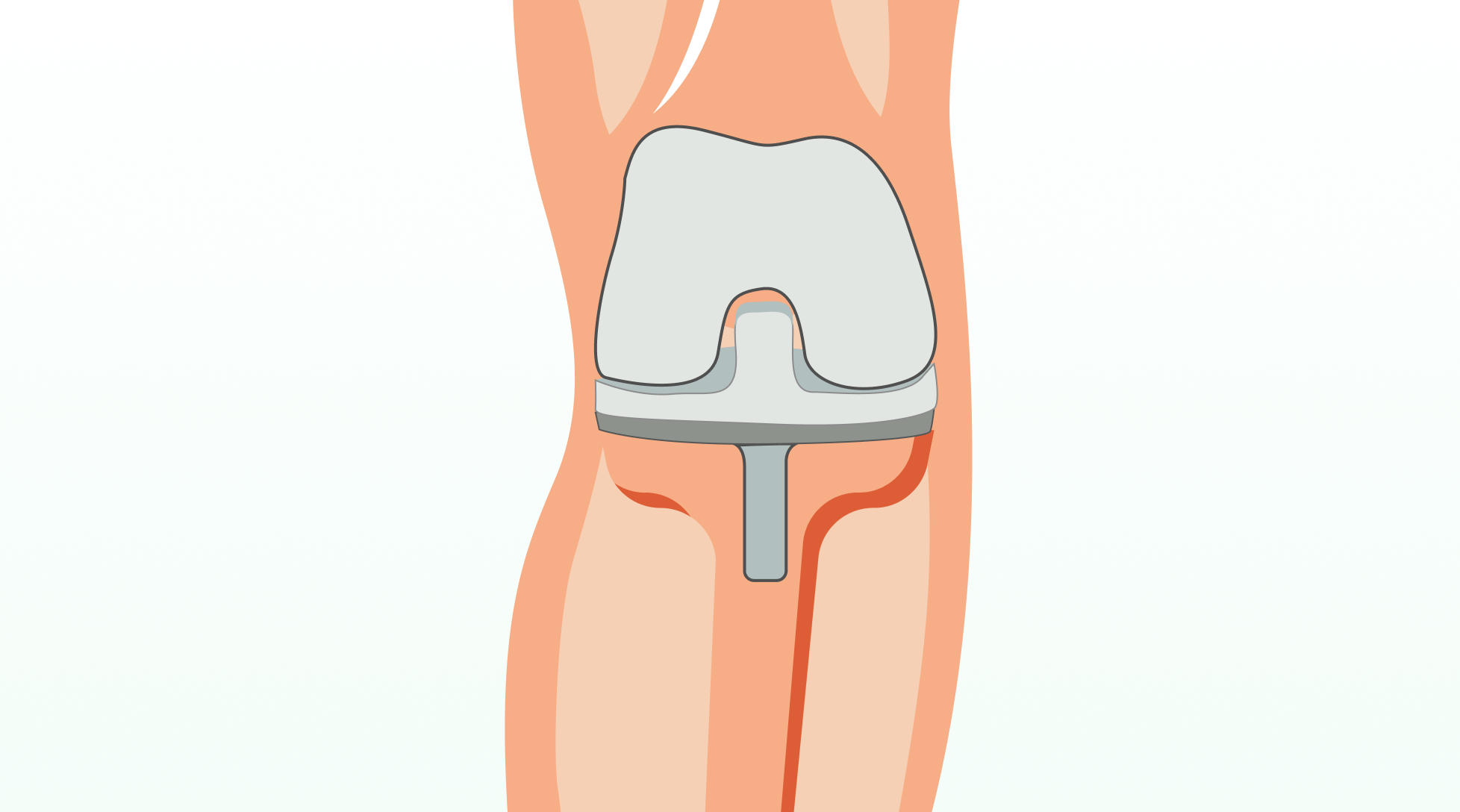 Knee replacement