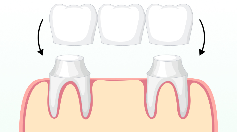 Dental bridge